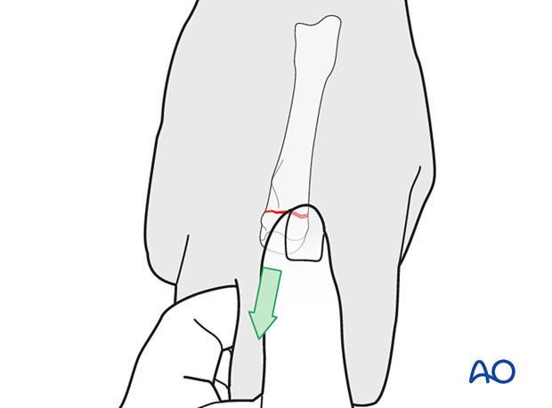 Reduction by manual traction of a transverse extraarticular fracture of the 3rd metacarpal head