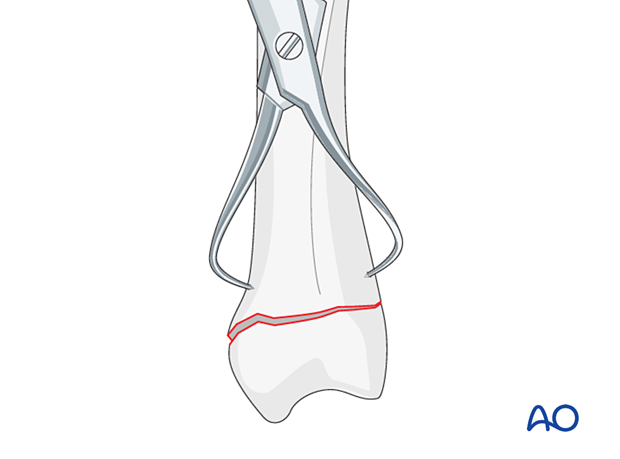 Reduction of a transverse extraarticular fracture of the metacarpal base with reduction forceps