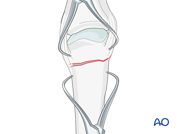 Reduction of a transverse extraarticular fracture of the metacarpal head with reduction forceps