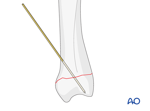 K-wire inserted to provisionally hold reduction of a transverse extraarticular fracture of the metacarpal base