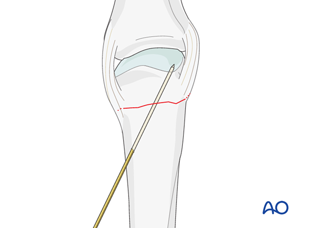 K-wire inserted to provisionally hold reduction of a transverse extraarticular fracture of the metacarpal head