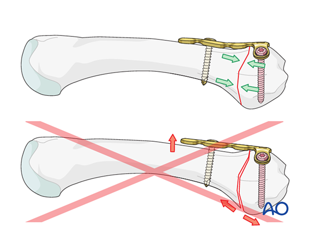 Contouring the plate in an overbent fashion relative to the bone surface to achieve compression across the whole fracture plane