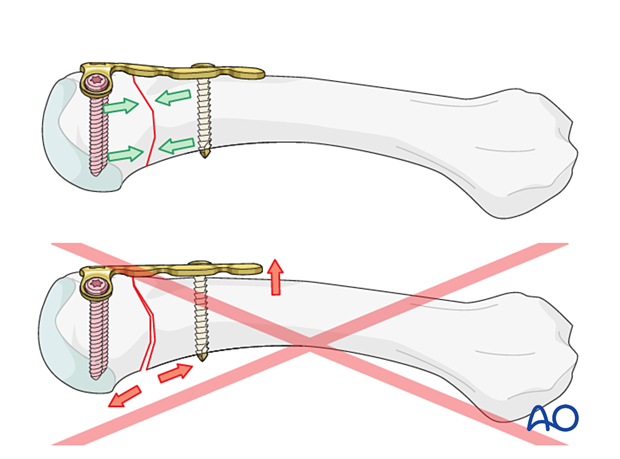 Contouring the plate in an overbent fashion relative to the bone surface to achieve compression across the whole fracture plane