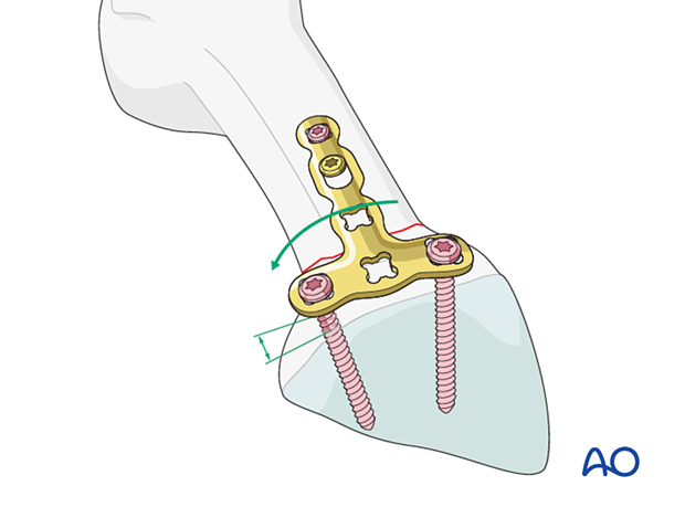 Adaptation of a T-plate to the shape of the metacarpal base