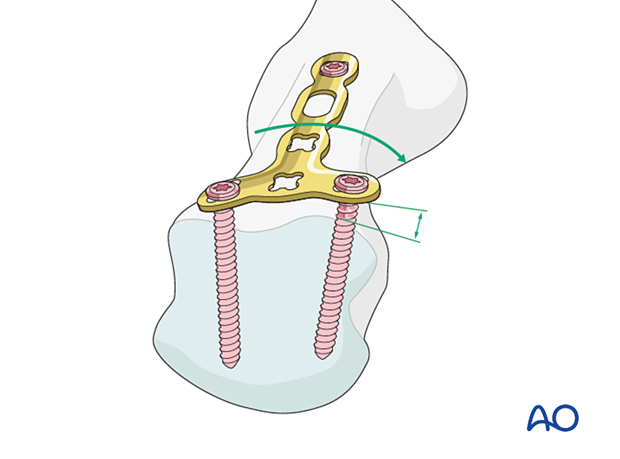 Adaptation of a T-plate to the shape of the metacarpal head