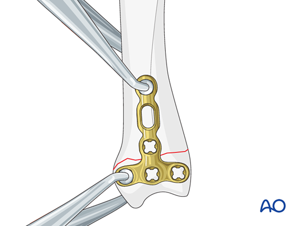 Compression with a T-plate of a transverse extraarticular fracture of the metacarpal base – plate positioning