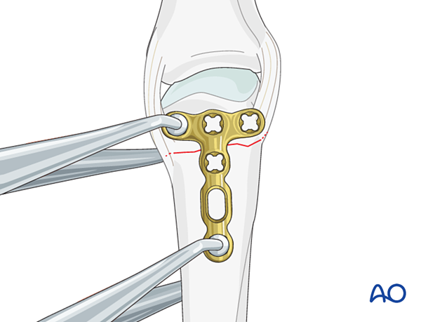 Compression with a T-plate of a transverse extraarticular fracture of the metacarpal head – plate positioning