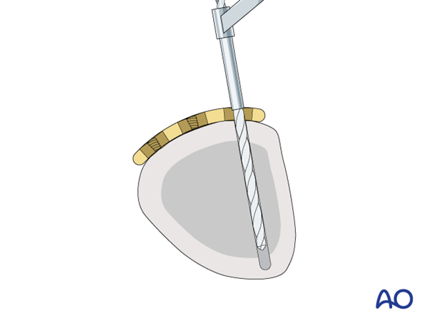 Compression with a T-plate of a transverse extraarticular fracture of the metacarpal base – proximal screw insertion