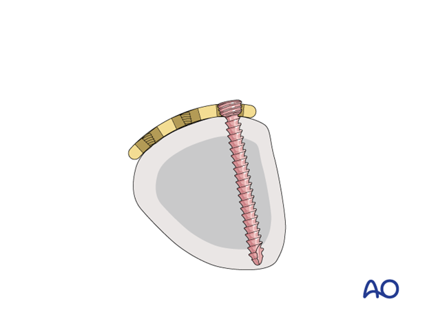 Compression with a T-plate of a transverse extraarticular fracture of the metacarpal base – proximal screw insertion