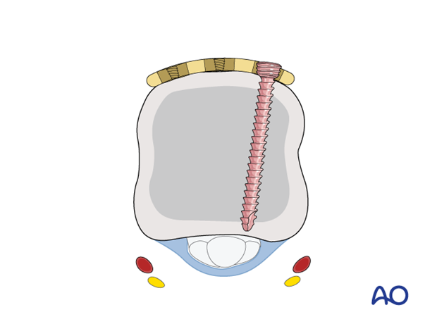 Compression with a T-plate of a transverse extraarticular fracture of the metacarpal head – proximal screw insertion