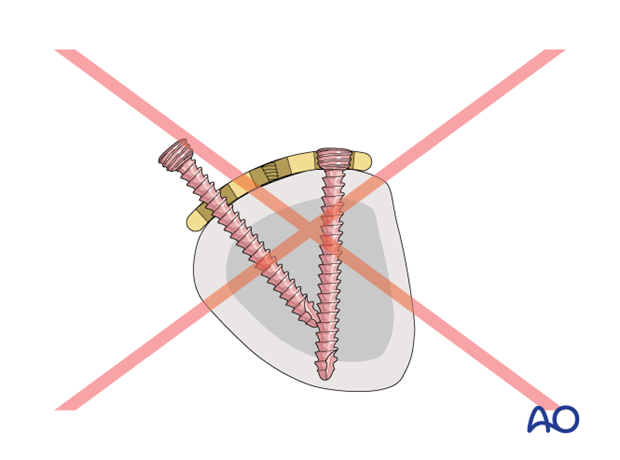 Compression with a T-plate of a transverse extraarticular fracture of the metacarpal base – interfering screws