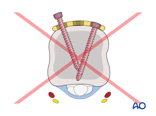 Compression plating for Extraarticular fracture of the distal end segment