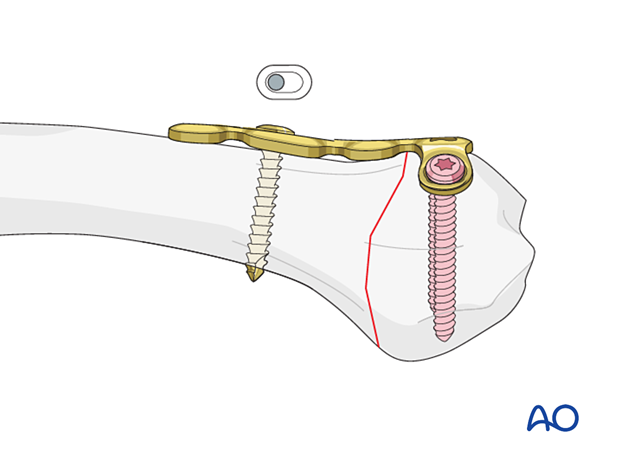 Compression with a T-plate of a transverse extraarticular fracture of the metacarpal base – Screw insertion and compression