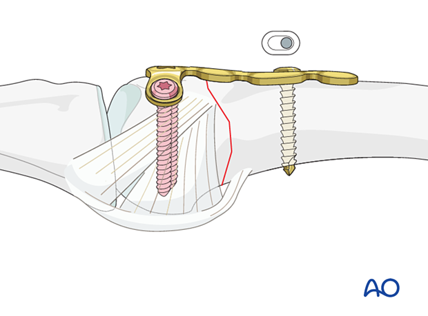 Compression with a T-plate of a transverse extraarticular fracture of the metacarpal base – Screw insertion and compression