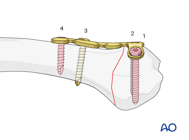 Compression with a T-plate of a transverse extraarticular fracture of the metacarpal base – Order of screw insertion