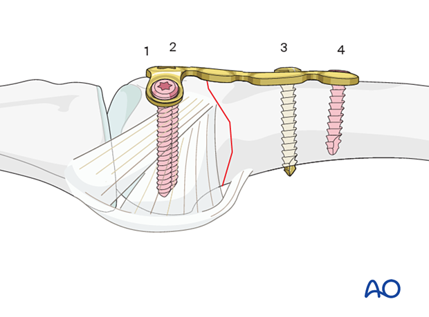 Compression with a T-plate of a transverse extraarticular fracture of the metacarpal head – Order of screw insertion