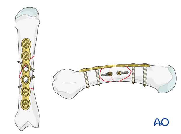 Lag-screw and plate fixation of a multifragmentary fracture of the metacarpal shaft