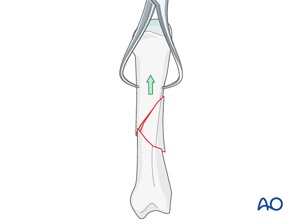 Multifragmentary fracture of the metacarpal shaft – Reduction by traction