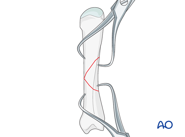 Multifragmentary fracture of the metacarpal shaft – Holding the reduction with forceps