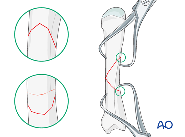 Multifragmentary fracture of the metacarpal shaft – Holding the reduction with forceps