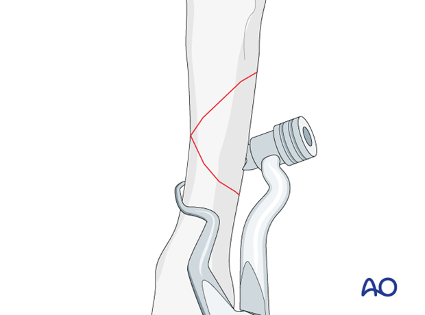 Multifragmentary fracture of the metacarpal shaft – Holding the reduction with forceps designed for percutaneous fixation