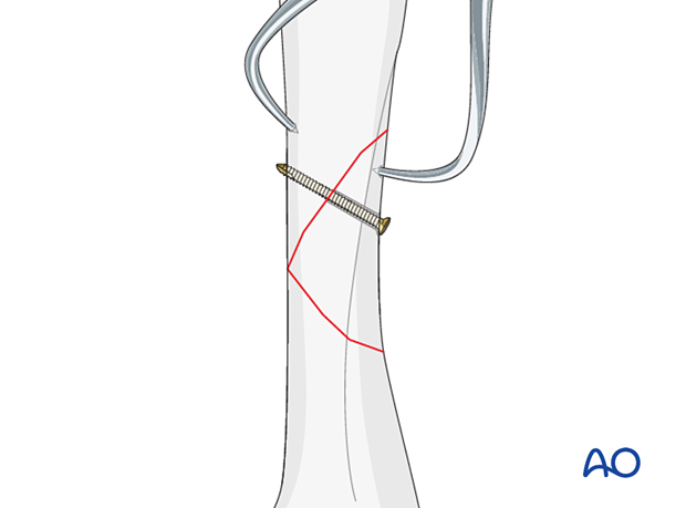 Lag-screw and plate fixation of a multifragmentary fracture of the metacarpal shaft – Insertion of first lag screw