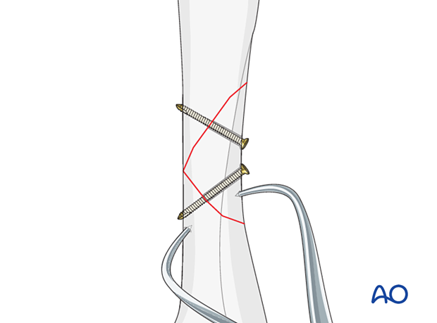 Lag-screw and plate fixation of a multifragmentary fracture of the metacarpal shaft – insertion of lag screws