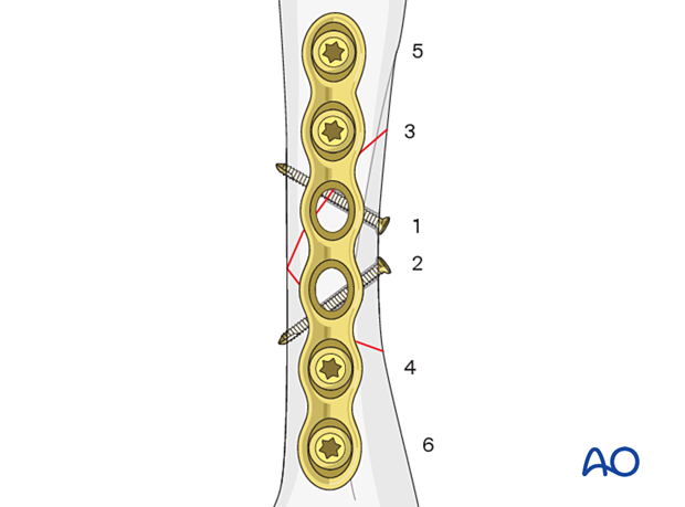 Lag-screw and plate fixation of a multifragmentary fracture of the metacarpal shaft – order of screw insertion