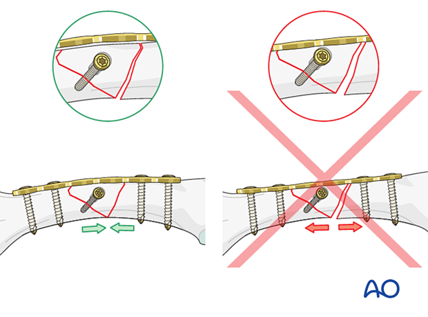 Lag-screw and plate fixation of a multifragmentary fracture of the metacarpal shaft – compression plating