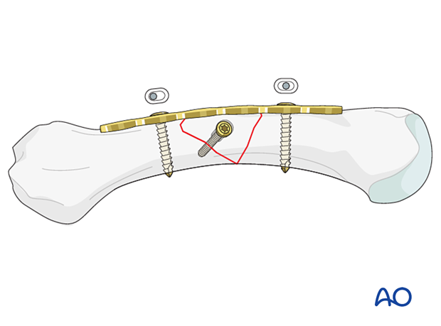 Lag-screw and plate fixation of a multifragmentary fracture of the metacarpal shaft - Compression plating