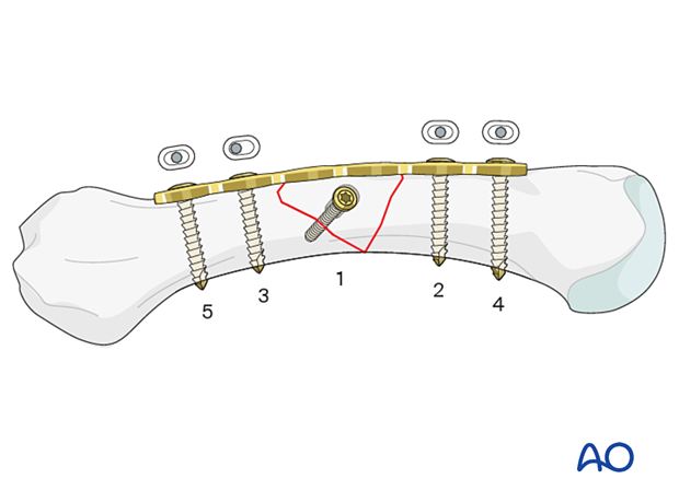 Lag-screw and plate fixation of a multifragmentary fracture of the metacarpal shaft - Compression plating