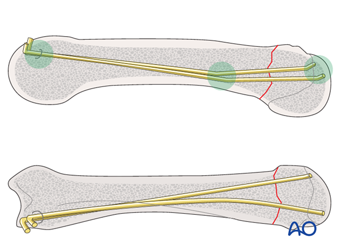 Intramedullary K Wire Fixation For Extraarticular Fracture Of The