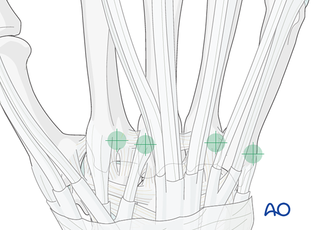 Entry points for antegrade intramedullary screw fixation of transverse metacarpal fractures