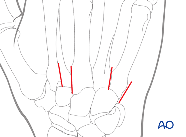 Skin incisions for intramedullary K-wire fixation of extraarticular metacarpal head fractures