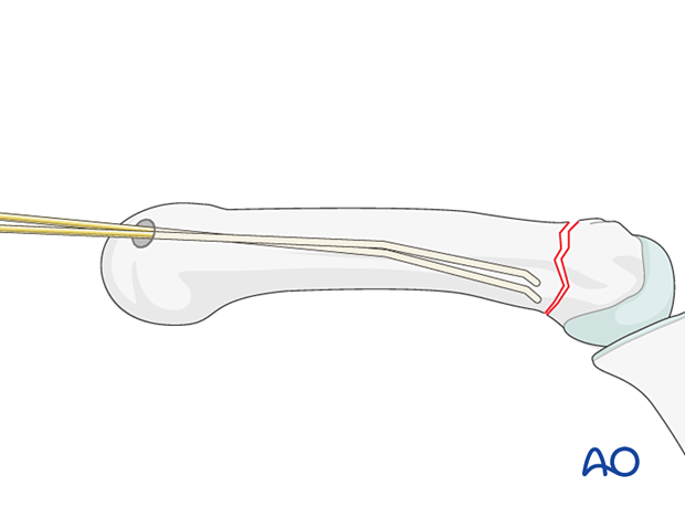 Intramedullary K-wire fixation of extraarticular metacarpal head fractures – Wire insertion