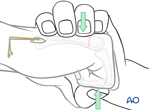 Intramedullary K-wire fixation of extraarticular metacarpal head fractures – Preliminary reduction