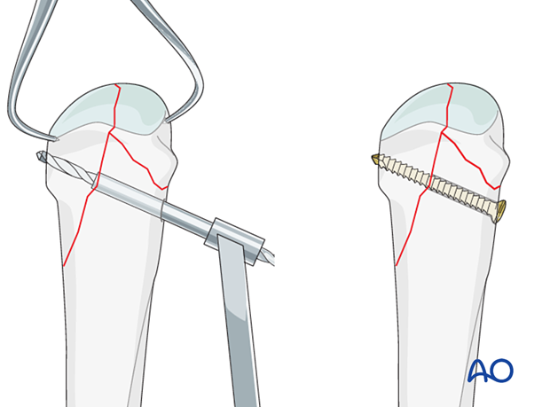 Screw fixation of a complete articular fracture of the metacarpal head – lag-screw insertion