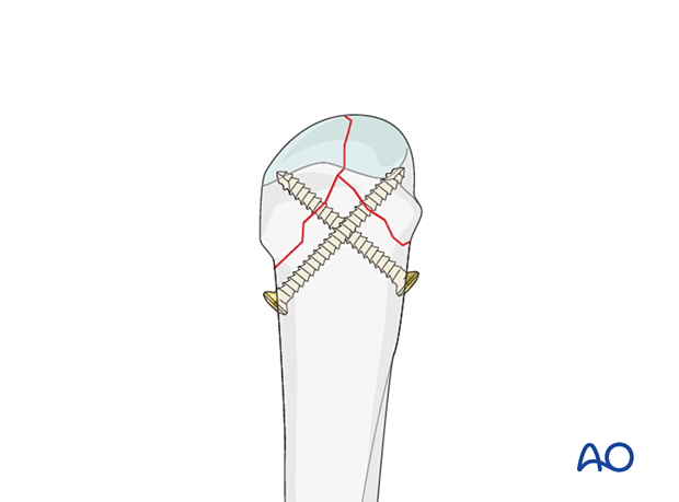 Screw fixation of a complete articular fracture of the metacarpal head