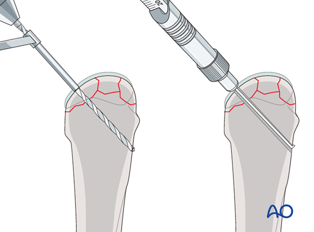 Screw fixation of a complete articular fracture of the metacarpal head – drilling and screw length determination for fixation of small fragments