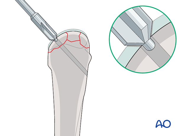 Screw fixation of a complete articular fracture of the metacarpal head – countersinking of the articular cartilage