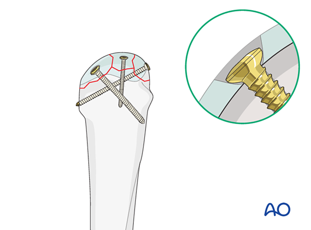 Screw fixation of a complete articular fracture of the metacarpal head – fixation of small fragments