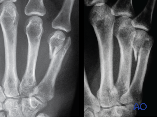 Preoperative AP and oblique x-rays showing a case of an oblique partial articular fracture of the 5th metacarpal head