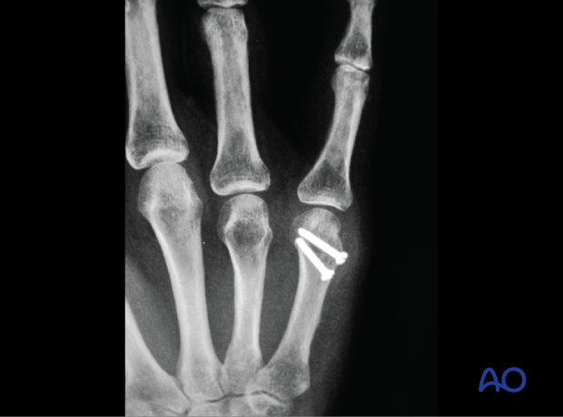 AP x-rays showing a case of an oblique partial articular fracture of the 5th metacarpal head stabilized with screws