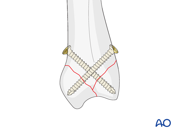 Screw fixation of a complete articular fracture of a metacarpal base