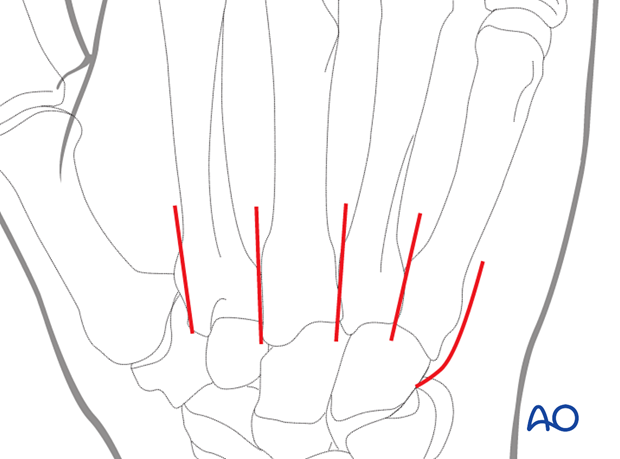 Dorsal approach to the carpometacarpal joints