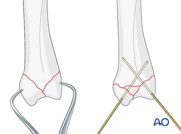 Reduction of a complete articular fracture of a metacarpal base