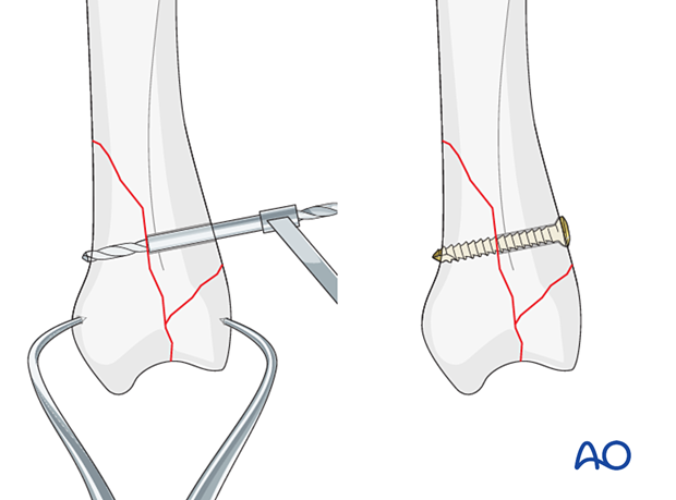 Screw fixation of a complete articular fracture of a metacarpal base – Screw insertion in large fragments