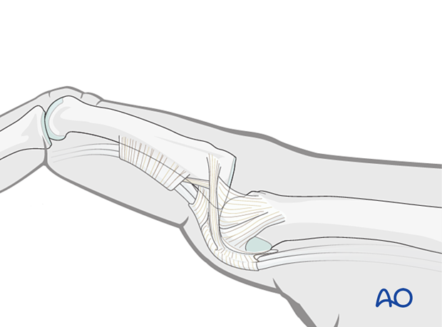 Dislocation usually occurs as an extension deformity.