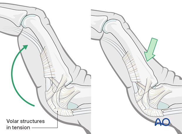 Maneuvers for reduction of a MCP dislocation