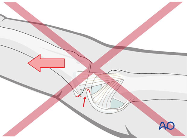 Pitfall of closed reduction of a metacarpophalangeal joint dislocation by traction